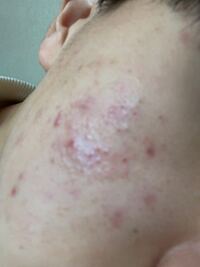 2 3ヶ月前に皮膚科に行ってベピオゲルというお薬を処方されました Yahoo 知恵袋