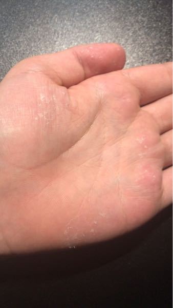 水虫 解決済みの質問 Yahoo 知恵袋