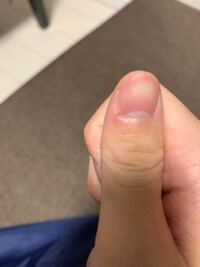 手の指にトゲが刺さっていて取れません ほんの少しだけ腫れていますどう取る Yahoo 知恵袋