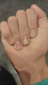 爪をいじってしまって爪が根元から剥がれてなくなってしまいました これはもう Yahoo 知恵袋