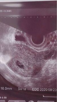 はじめまして 初めての妊娠で胎嚢確認が出来たのですが 胎嚢の中に白い線 Yahoo 知恵袋