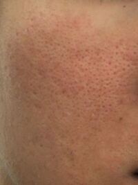 閲覧注意 毛穴の開きがひどいです34歳女頬と小鼻にかけて毛穴が Yahoo 知恵袋