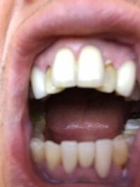 歯と歯茎の間に黒や茶色の部位があり 歯科で見てもらいましたが 虫歯ではなく歯 Yahoo 知恵袋