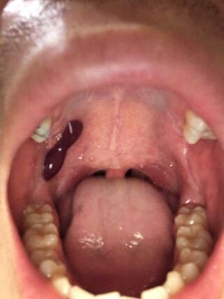 いきなり口の中に口内炎 黒くて柔らかいものができました これはなんなの Yahoo 知恵袋