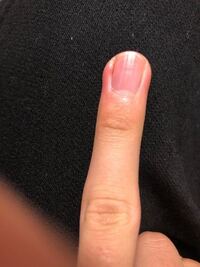 おそらく爪周囲炎になってしまいました 皮膚科に受診したほうがいいでしょ Yahoo 知恵袋