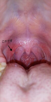 喉 白い 口内炎 痛くない