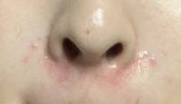 鼻の下と小鼻が赤くなり プツプツが出来ます 日によって 赤みがなか Yahoo 知恵袋