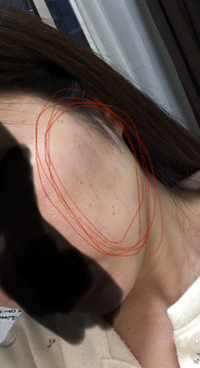 頰に出来た黒い跡について 画像あり 画像では分かりにくいかもしれませんが Yahoo 知恵袋
