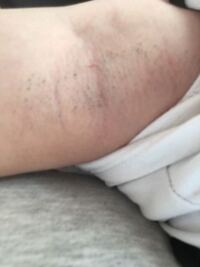 閲覧注意 陰部が痒いし痛い 数日前まで生理でナプキン蒸れ Yahoo 知恵袋