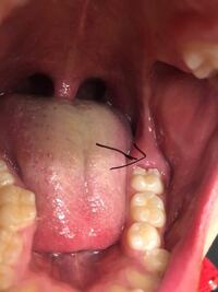 親知らずの近くの歯茎が痛い なんか親知らずの近く奥歯のあたりの歯茎が痛い Yahoo 知恵袋