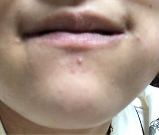 写真汚くてすみません 最近顎付近にニキビが増えてきて痒いです 耳の Yahoo 知恵袋