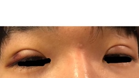 二重埋没手術5日目です 腫れが一向にひきません こんなもんですか 突っ張 Yahoo 知恵袋