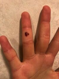 今日指挟んだら血豆ができました 血豆は針でさして皮を破るって聞いたの Yahoo 知恵袋