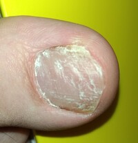 爪の表面が凸凹し 層状になってしまいました これは爪白癬でしょうか 水虫自体 Yahoo 知恵袋