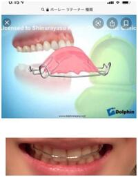 二年間の歯列矯正を終え 取り外し可能の上の画像のようなリテーナーつけてるので Yahoo 知恵袋