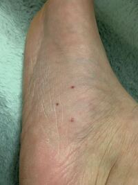 写真の足に赤い点が3つ出来たんですがこれは水虫めすか Yahoo 知恵袋