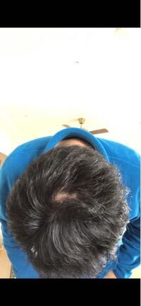 画像あり これはてっぺんハゲでしょうか Yahoo 知恵袋