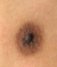 男子高生です 中学生の時から右側の乳首にだけ黒い何かがあります特に症状は Yahoo 知恵袋