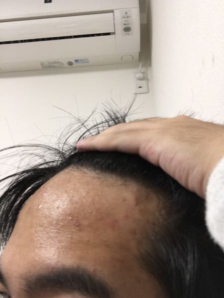 現在18歳です 親からは生まれつきおでこは広いと言われており 親もおでこが Yahoo 知恵袋