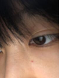 朝起きた時は無かったのですが 今2度目に鏡を見たら画像にもあるよう Yahoo 知恵袋