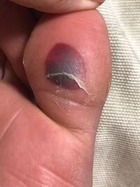 これって血豆ですかね 足の指にできたんですけど 血豆だったとしたら 歩いたり Yahoo 知恵袋