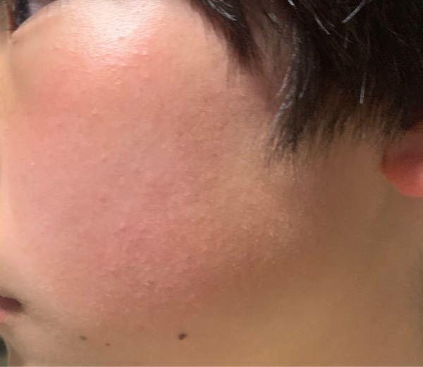 小さい頃から頬が赤く 熱いです 季節関係なく赤くなるのですが 冬は特に赤いで Yahoo 知恵袋