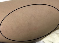 スパイダースキン下肢静脈瘤です 基本的に治ることはないと聞きましたが 初期の Yahoo 知恵袋