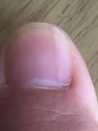 半年前ぐらいから親指の爪に薄黒い縦線がはいってるんですけど大きな病気ではない Yahoo 知恵袋