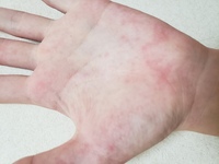 お風呂上がりに手が痒い赤い発疹が出てます一応軟膏塗りました水虫でし Yahoo 知恵袋