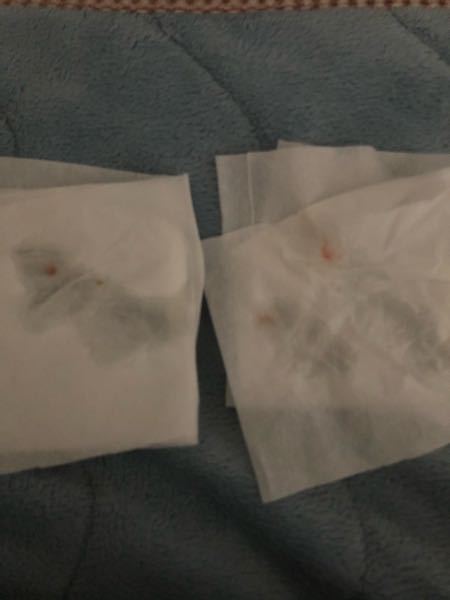 写真閲覧注意 血痰が出ました今 新型コロナウイルスが流行っ Yahoo 知恵袋