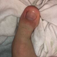 足の親指の爪切りすぎて数日経ったらこんなことになっていました とて Yahoo 知恵袋