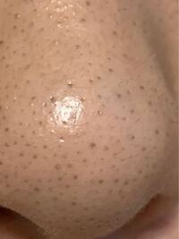 閲覧注意です この黒ずみなにをやっても取れないんですけど Yahoo 知恵袋