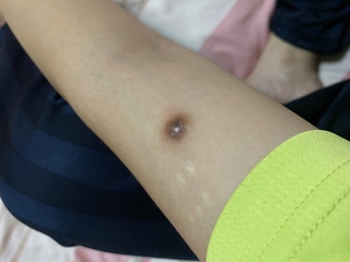 1年ほど前から二の腕に黒く少し膨らんだイボみたいなものがあります 触ると固く Yahoo 知恵袋