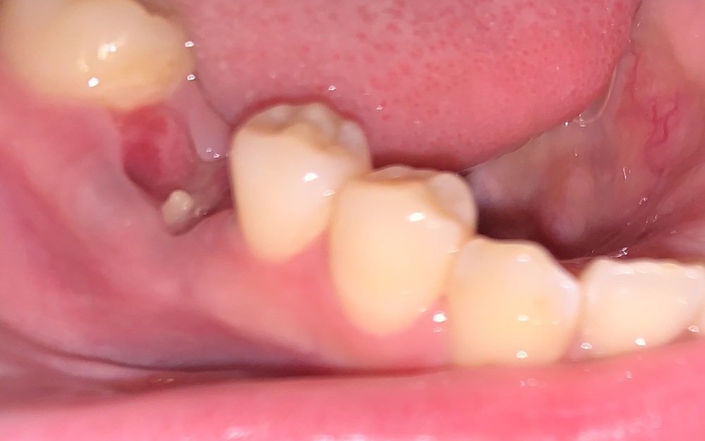 抜歯後の血餅について詳しい方教えてくださいm(__)m 昨... Yahoo!知恵袋
