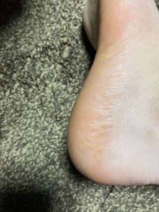 かかとに写真のようなぶつぶつがあるのですかなんなのでしょうか 明日皮膚 Yahoo 知恵袋