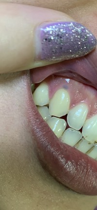 萌出嚢胞 とは 子どもの歯茎に黒紫の水ぶくれができたら なごみ小児歯科クリニック
