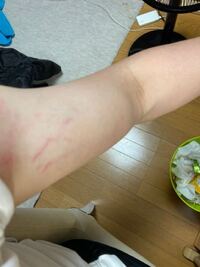 筋トレによる脇の肉割れについて 写真有注意 肉割れは治すこと 目立た Yahoo 知恵袋