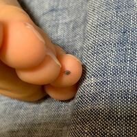 2歳の息子の足の指に血豆 ホクロ が出来ています ホクロでし Yahoo 知恵袋