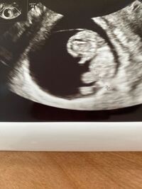 エコーでのntというのが どういうものかよくわかりません 現在9週6日 Yahoo 知恵袋