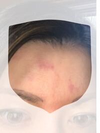 妊娠中です 6ヶ月目くらいから 顔や脚に写真のようなアザが出できて Yahoo 知恵袋