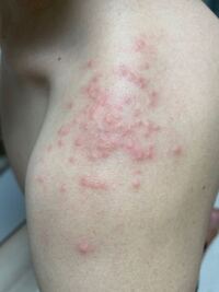 朝起きたら虫刺されのようなものが出来ていました ふとしたとき痒みがあり Yahoo 知恵袋