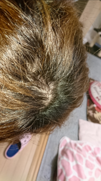 ストレスなのか 頭皮ニキビが原因なのかわかりませんが 頭のてっぺんが薄くなり Yahoo 知恵袋