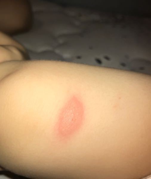 昨日から子供の足に虫刺されの様な跡があり 今日になって増えていましたこの Yahoo 知恵袋