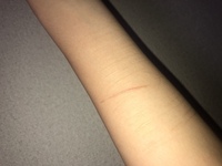 手術で縫った傷について悩んでいます 一年近く経ちますが中々赤みが消えて Yahoo 知恵袋