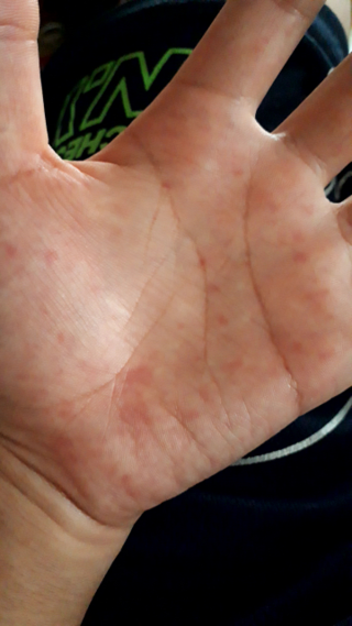 今日の朝急に手のひらと手の甲に赤い斑点が出てきました 特に痛みも痒 Yahoo 知恵袋
