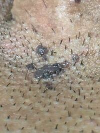 閲覧注意汚い画像ですみません以前陰部を剃毛した際 埋没毛ができてし Yahoo 知恵袋