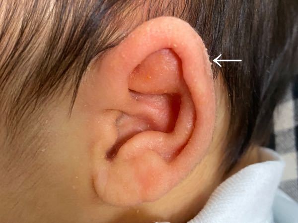新生児 ダウン症 耳 新生児 ダウン症 耳の位置