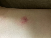 この虫刺されは何の虫ですか すごくかゆいです最初は蚊だと思ってたんですけど Yahoo 知恵袋