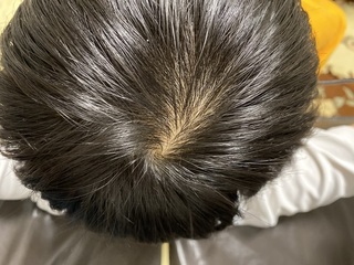 これはつむじはげですよね 16歳男子です つむじを触る癖があり その時に抜け Yahoo 知恵袋