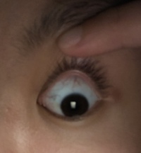 中学3年生です 2年前くらいからずっと白目の血管が目立つようになり Yahoo 知恵袋